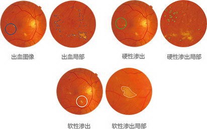 病变量化检测