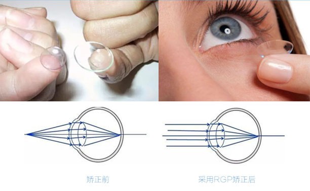 隐形眼镜配戴者最理想的选择